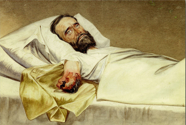 a solider wounded by a Minié rifle